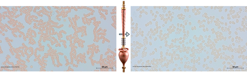 Comparaison du sang avant et après biodynamisation avec désempilement des globules rouges.